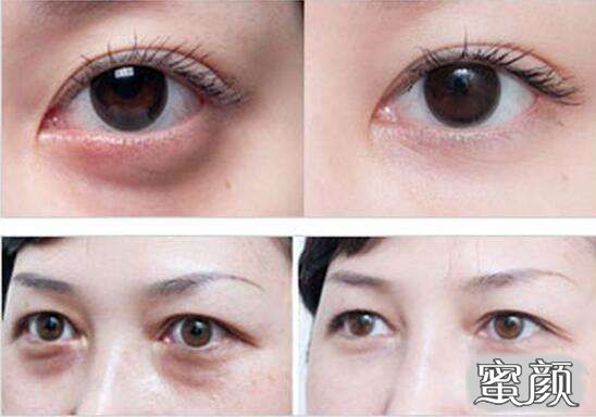 科技揭秘，最新去眼袋最佳方法，重塑眼部美麗新篇章！